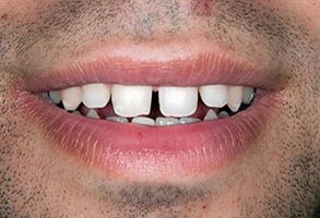 Unident Group PC | Ceramic Crowns, Dental Fillings and TMJ Disorders